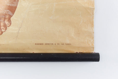 Vintage Small Anatomical Poster of a Broken Leg