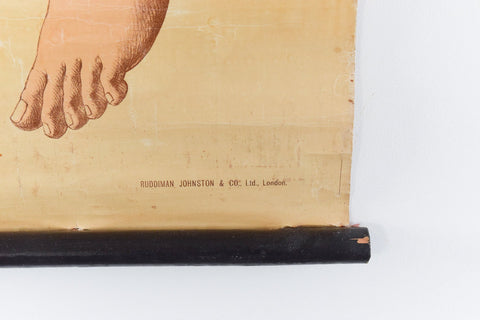 Vintage Small Anatomical Poster of a Broken Leg
