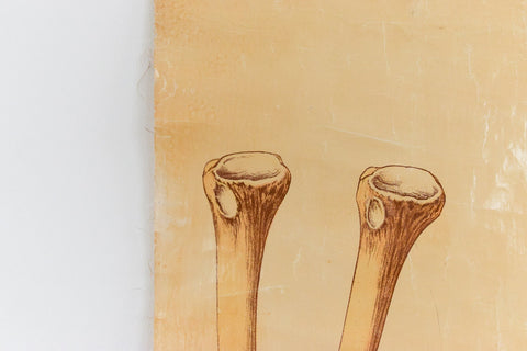 Vintage Small Anatomical Poster of a Broken Leg